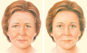 Brow Lift: Eyebrow Lift, Forehead Lift | American Society of Plastic ...