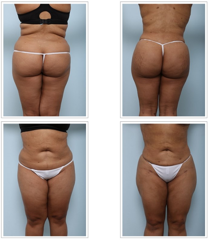 Buttock Augmentation, Brazilian Butt Lift Surgery