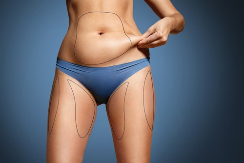 Liposuction- To Give a Well-Sculpted Look for Your Body!