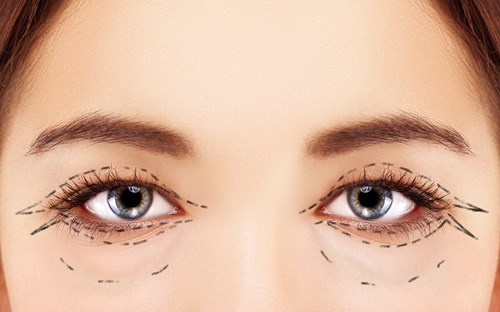 Top 5 Reasons You Should Choose Eyelid Surgery
