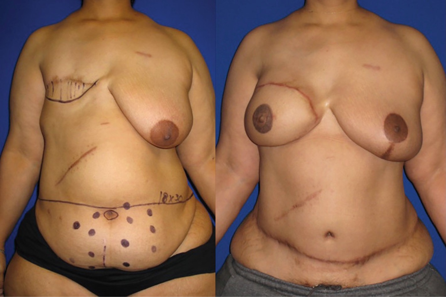 3 Cosmetic Breast Surgeries to Consider: Laughlin Plastic Surgery: Plastic  Surgeons