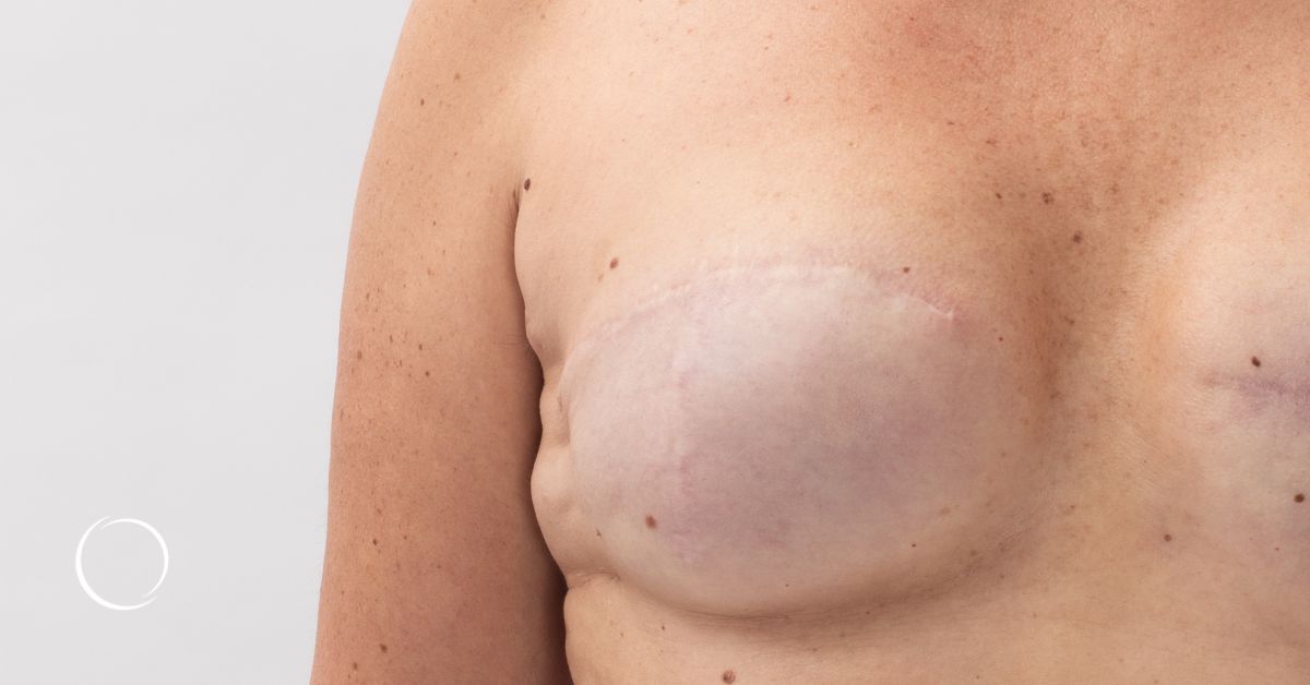 Breast Reconstruction - DIEP Flap - Before & After Photos