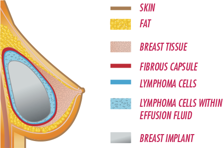 All about Breast Implant Sizes & Profiles