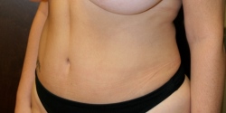 Breast Augmentation- A to a C Cup Before and After!  #breastaugmentationsurgery 