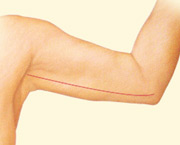 body contouring arm lift