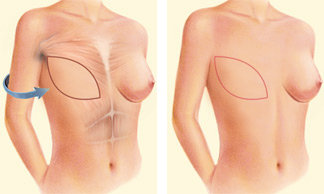 Breast Reconstruction Procedure Steps