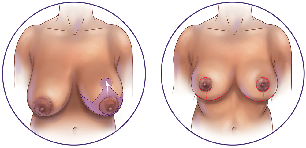 Breast Reduction Keyhole Incision