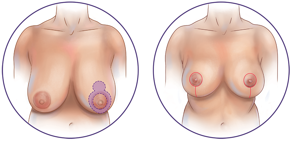Breast Reduction Lollipop Incision