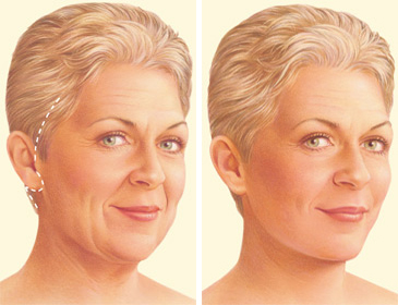 Cirugía estética facial - Serie—Indicaciones: MedlinePlus