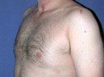laser assisted lipo after picture