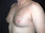 laser assisted lipo before picture