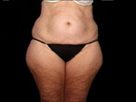laser assisted lipo before picture