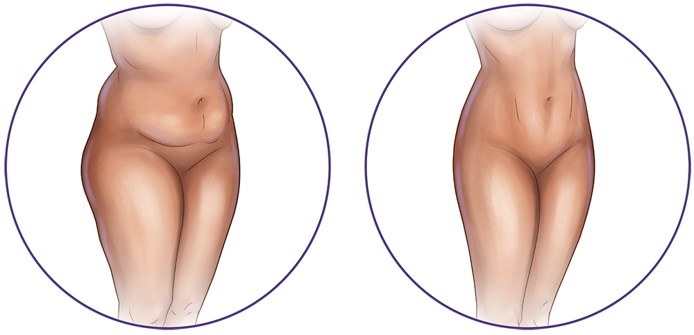 Different types of Liposuction: techniques & best options, newest