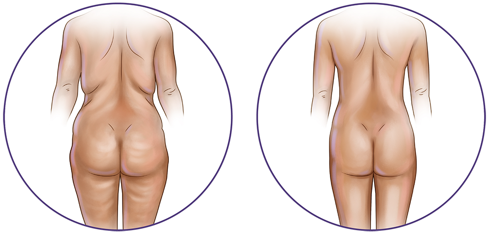 All of The Areas Of Body For Liposuction