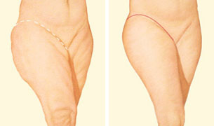 Inner Thigh Lift Without Scars