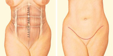 Que sucede durante la abdominoplastia?, Abdominoplastía