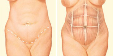 Abdominoplasty: The 3 Types of Tummy Tuck Procedures