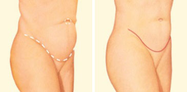 https://www.plasticsurgery.org/images/Procedures/Tummy-Tuck/tummy-tuck-side-before-after.jpg