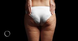 Battle of the bulge: What you can do about cellulite