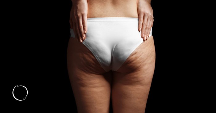 what plastic surgeons can do about cellulite