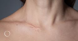 Summer in the sun, fall in the plastic surgeon's chair: What can you do about skin cancer scars?