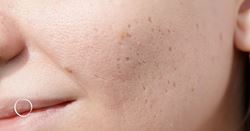 Erasing the unsightly signs of youth: Get rid of your teenage acne scars