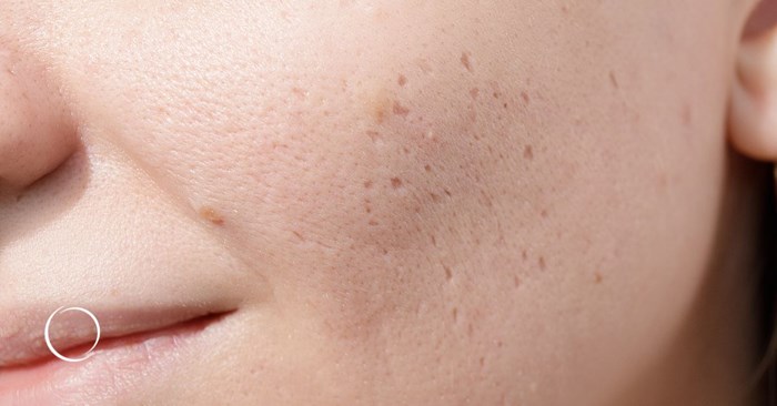 getting rid of your teenage acne scars